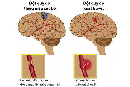 Nguy cơ tai biến, đột qụy vào mùa hè và cách phòng tránh Nguy cơ tai biến, đột qụy vào mùa hè và cách phòng tránh