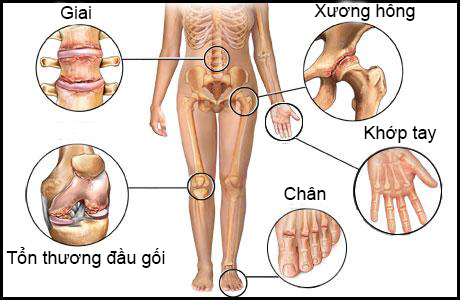 Các bệnh cơ xương khớp – mối nguy tiềm ẩn